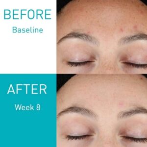 CeraVe Resurfacing Retinol Serum 30ml | Post-Acne Marks, Brightening & Pore Minimizer